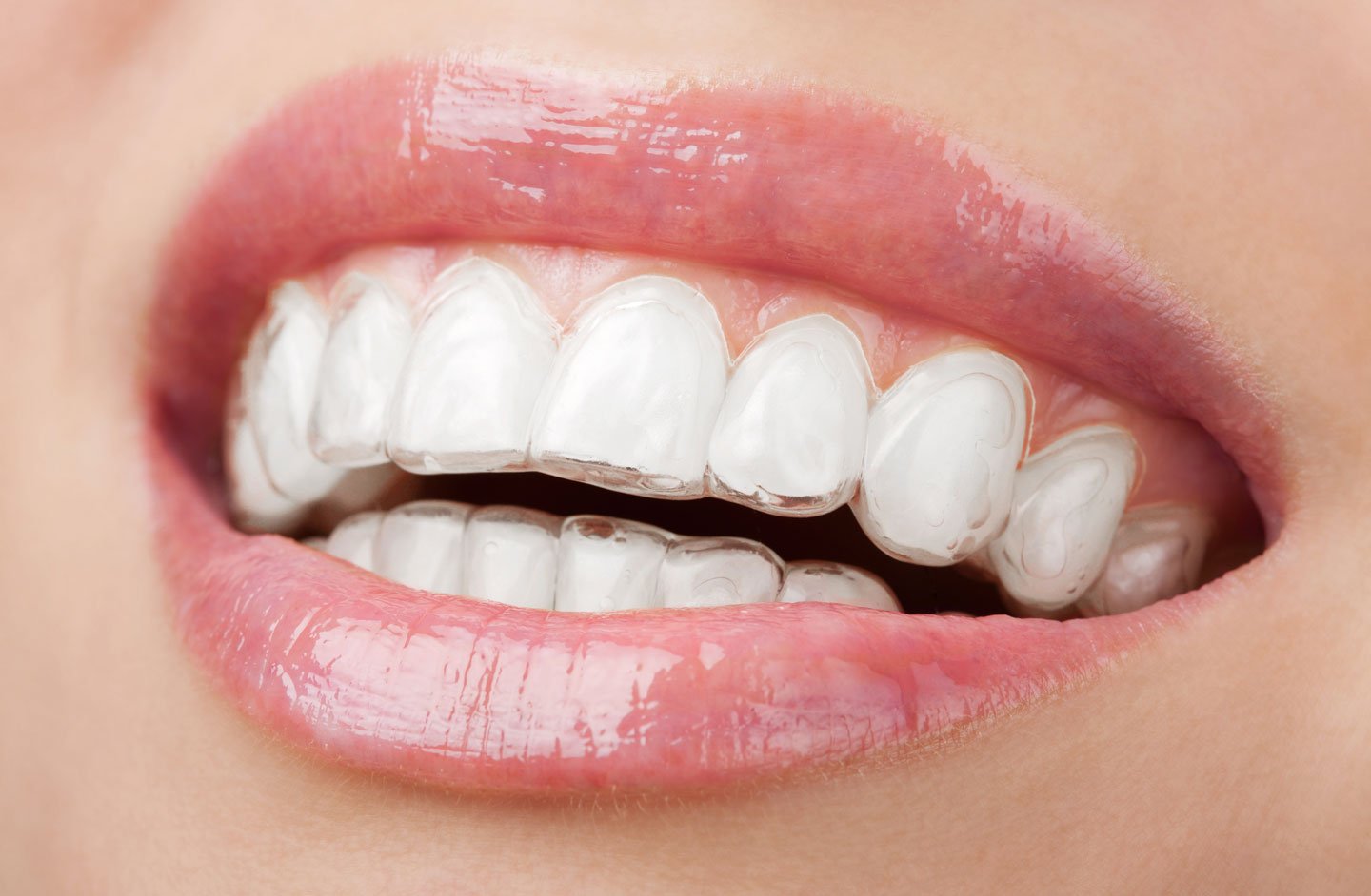 invisalign.jpg